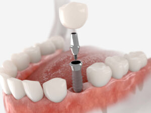 Einsatz eines Zahnimplantats im Unterkiefer