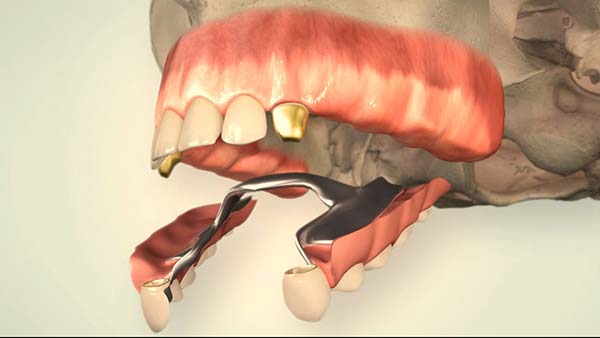 Herausnehmbarer Zahnersatz: Brückenprothese