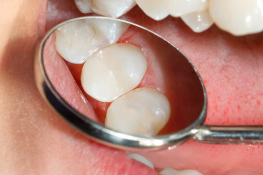 Zahnfarbene Füllung nach Kariesbehandlung