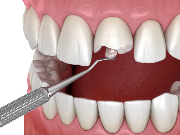 Zahnfarbene Komposit-Füllung für einen abgebrochenen Zahn
