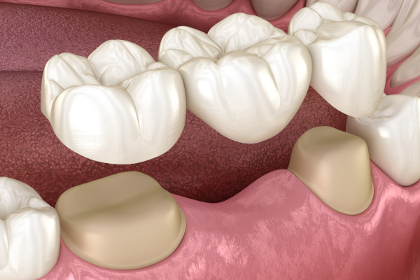 Zahnprothetik-Behandlung - Einsatz einer Teilprothese ohne Klammern