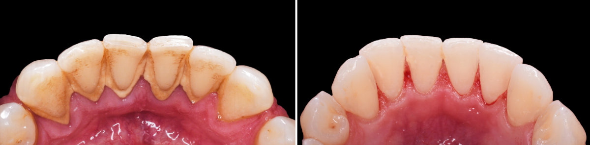 Zahnreinigung: Untere Zahnreihe vor und nach Zahnstein-Entfernung